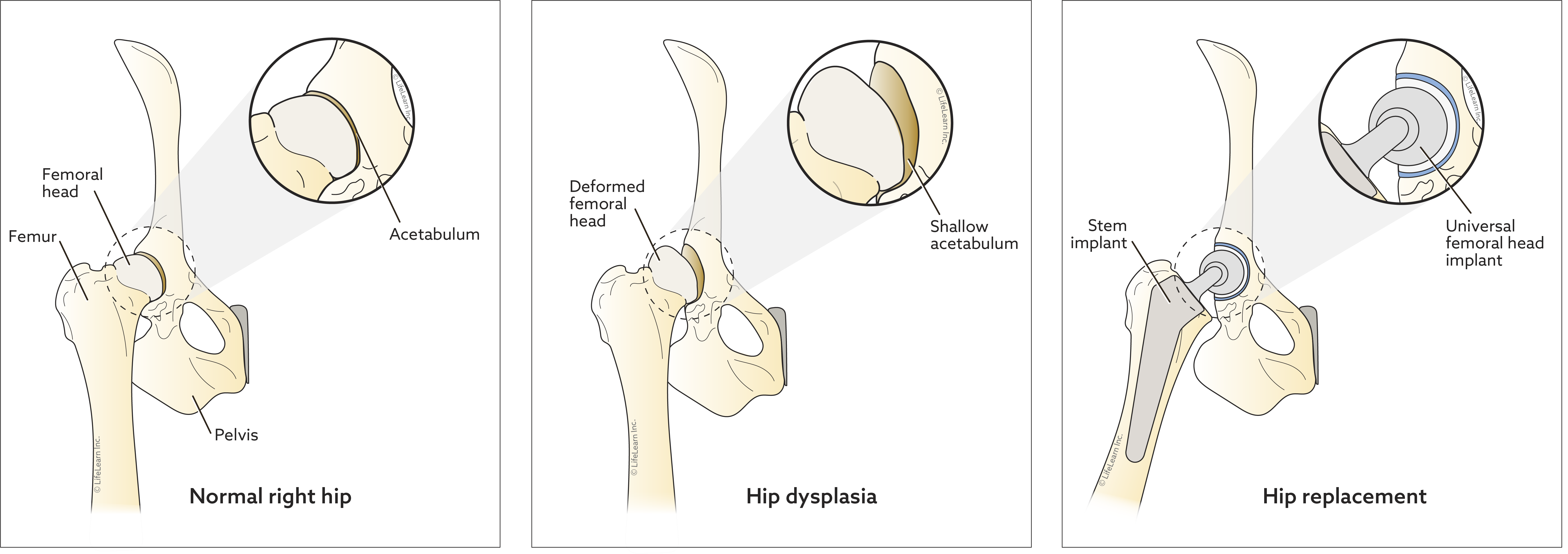 Hip replacement procedure illustration